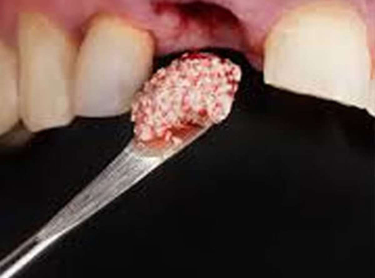 Dental Bone Grafting Delhi India Dental Bone Graft Surgery Cost Delhi India